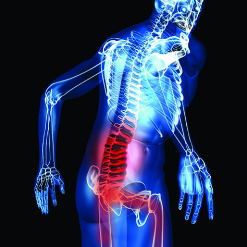 Corrective Exercise Guide for Anterior Pelvic Tilt
