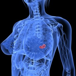 Exercise Oncology 101: Programming Workouts for Clients